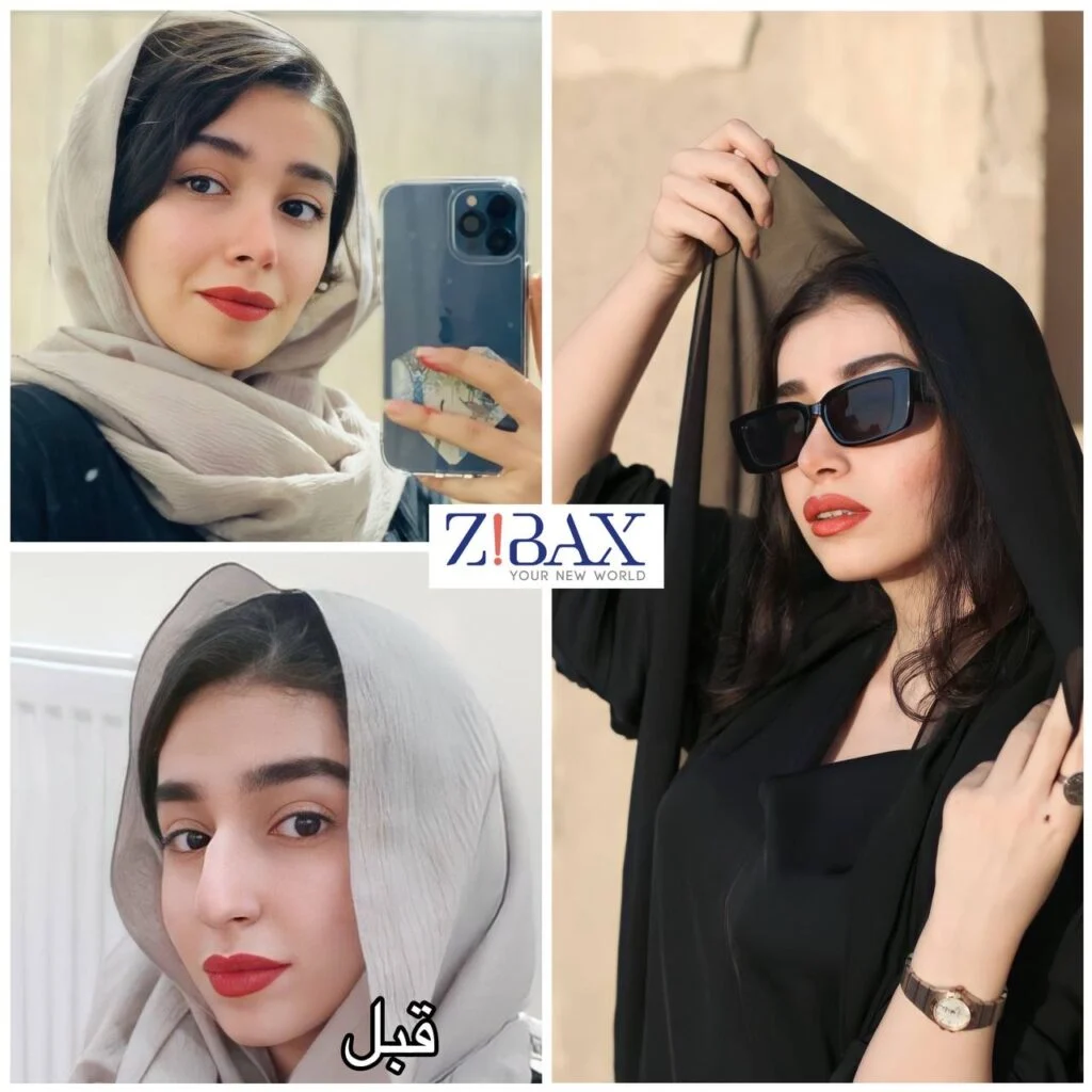 نمونه جراحی بینی استخوانی با مجموعه دکی یاب؛ بهترین جراح بینی در یزد