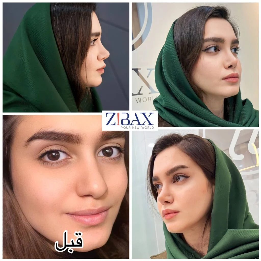 نمونه عمل بینی توسط مجموعه دکی یاب