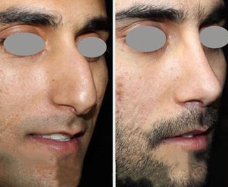 نمونه کار جراحی بینی طبیعی در شیراز دکتر پوستچی