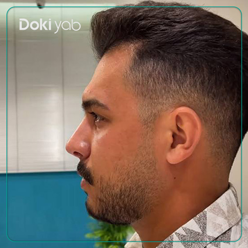 نمونه کار دکتر علیرضا مصباحی جراح بینی بسته در شیراز