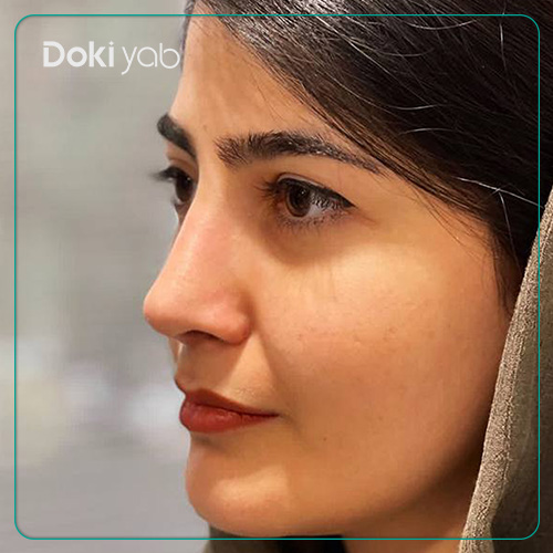 نمونه کار عمل بینی بسته دکتر علیرضا مصباحی در شیراز