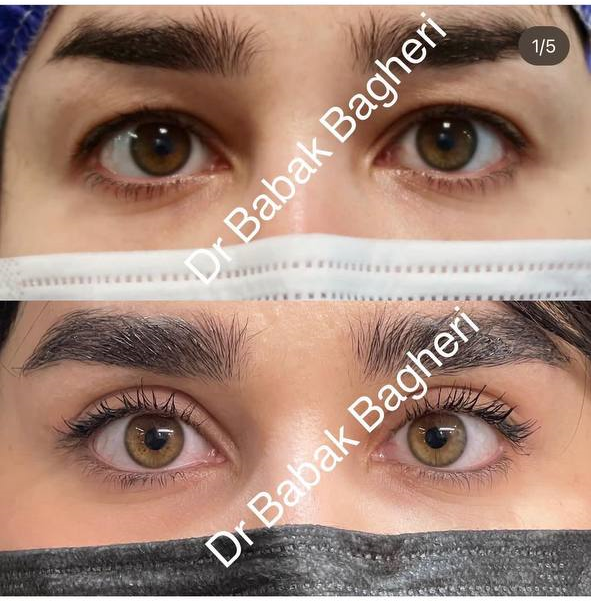 عمل بلفاروپلاستی با دکتر بابک باقری جراح زیبایی پلک و چشم در شیراز