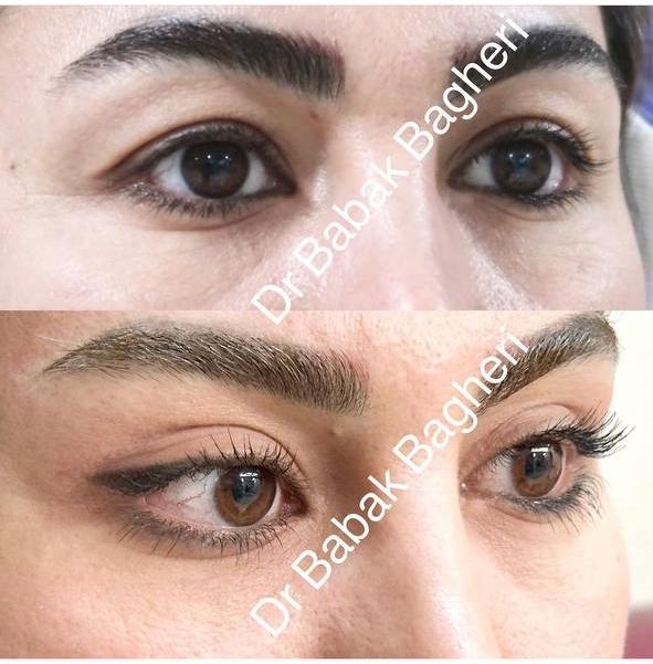 نمونه عمل بلفاروپلاستی چشم توسط دکتر بابک باقری در شیراز