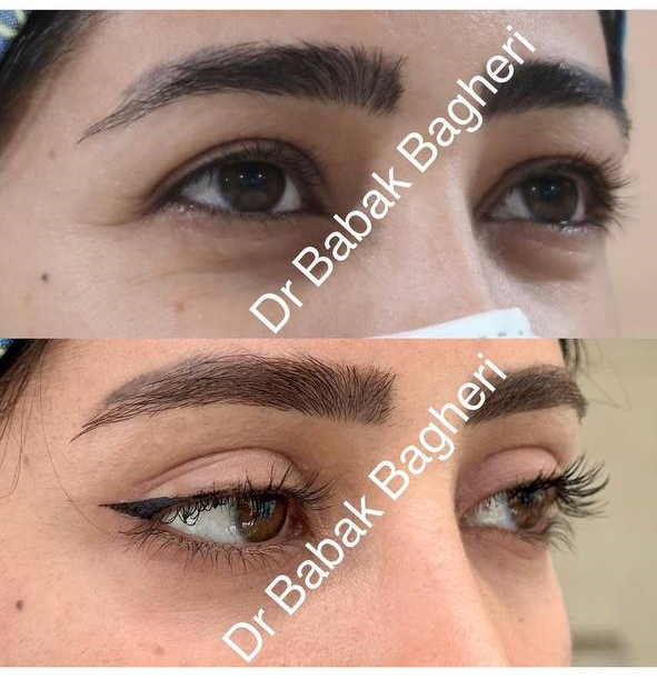 نمونه عمل دکتر بابک باقری جراح زیبایی پلک و چشم در شیراز