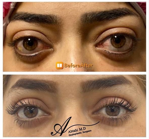نمونه کار دکتر محمد باقر ابطحی جراح پلاستیک چشم در شیراز