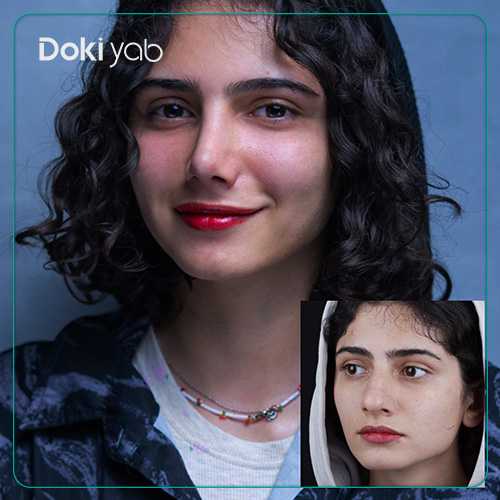 عمل بینی گوشتی به سبک نچرال با مشاوره دکی یاب
