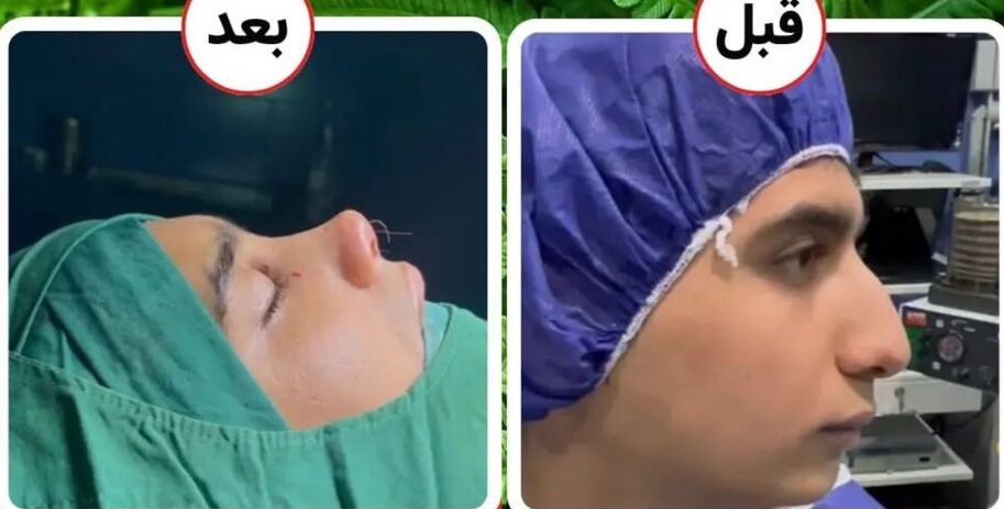 نمونه جراحی بینی عروسکی دکتر حمید نوری با مشاوره مجموعه دکی یاب در شیراز