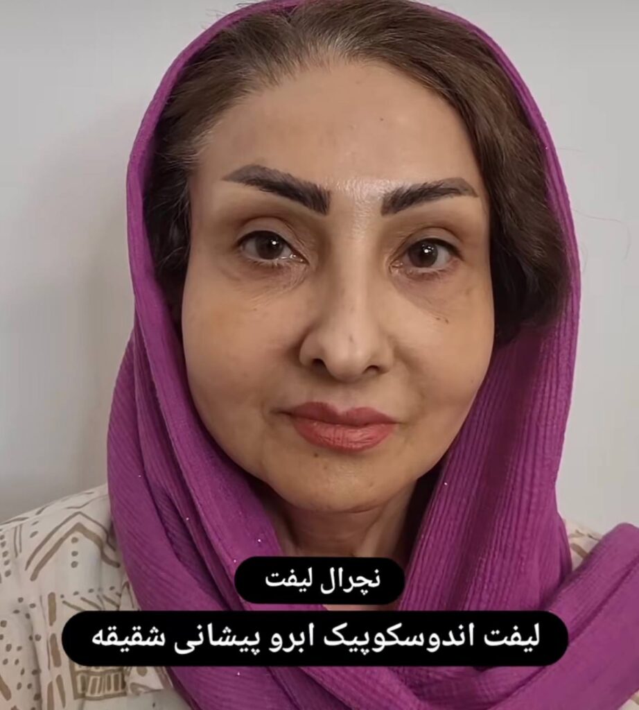 لیفت ابرو با دکتر بابک نادری جراح پلاستیک در تهران