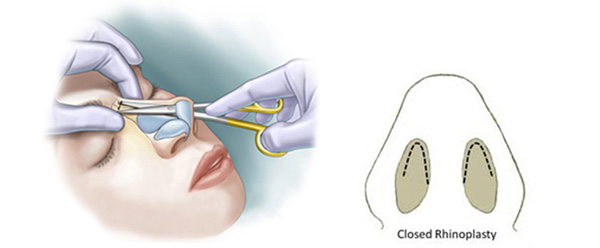 جراحی بینی به روش پرزرویشن چیست؟