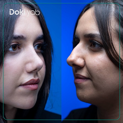 نمونه عمل بینی طبیعی دکتر سولماز قربانی؛ مجموعه دکی یاب
