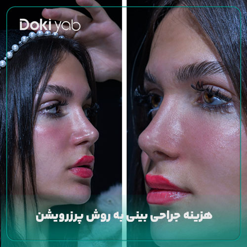 هزینه عمل بینی پرزرویشن در شیراز