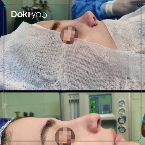 نمونه جراحی بینی طبیعی با دکتر بابک خسرویان