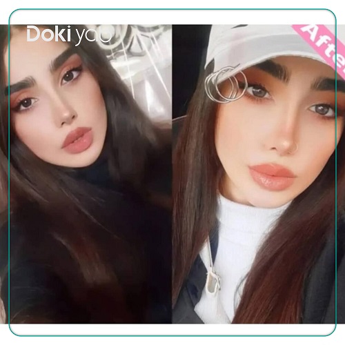 نمونه عمل بینی با دکتر آرزو خوانساری نیا بهترین دکتر عمل بینی در تهران