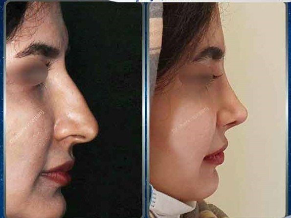 نمونه جراحی بینی با دکتر سپنج بهترین جراح بینی طبیعی و نچرال در تهران