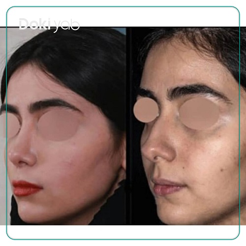 نمونه کار دکتر شهریار یحیوی جراح بینی فانتزی در تهران