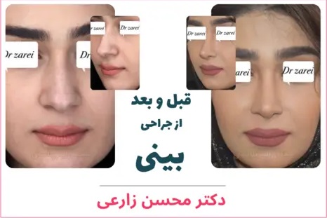 نمونه جراحی بینی توسط دکتر محسن زارعی؛ جراح بینی در اردبیل
