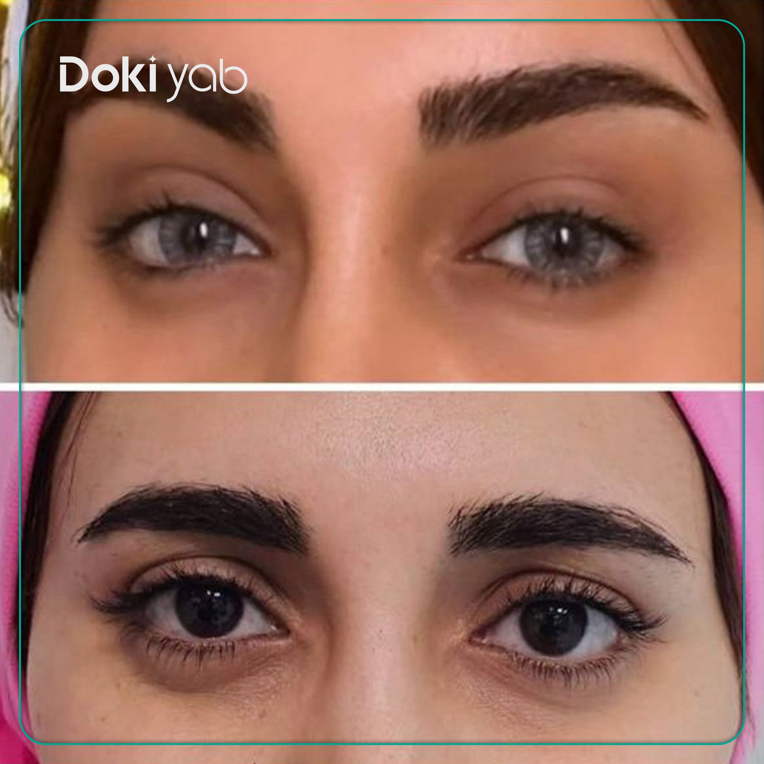 جراحی لیفت شقیقه به رو ش اندوسکوپیک با مشاوره دکی یاب
