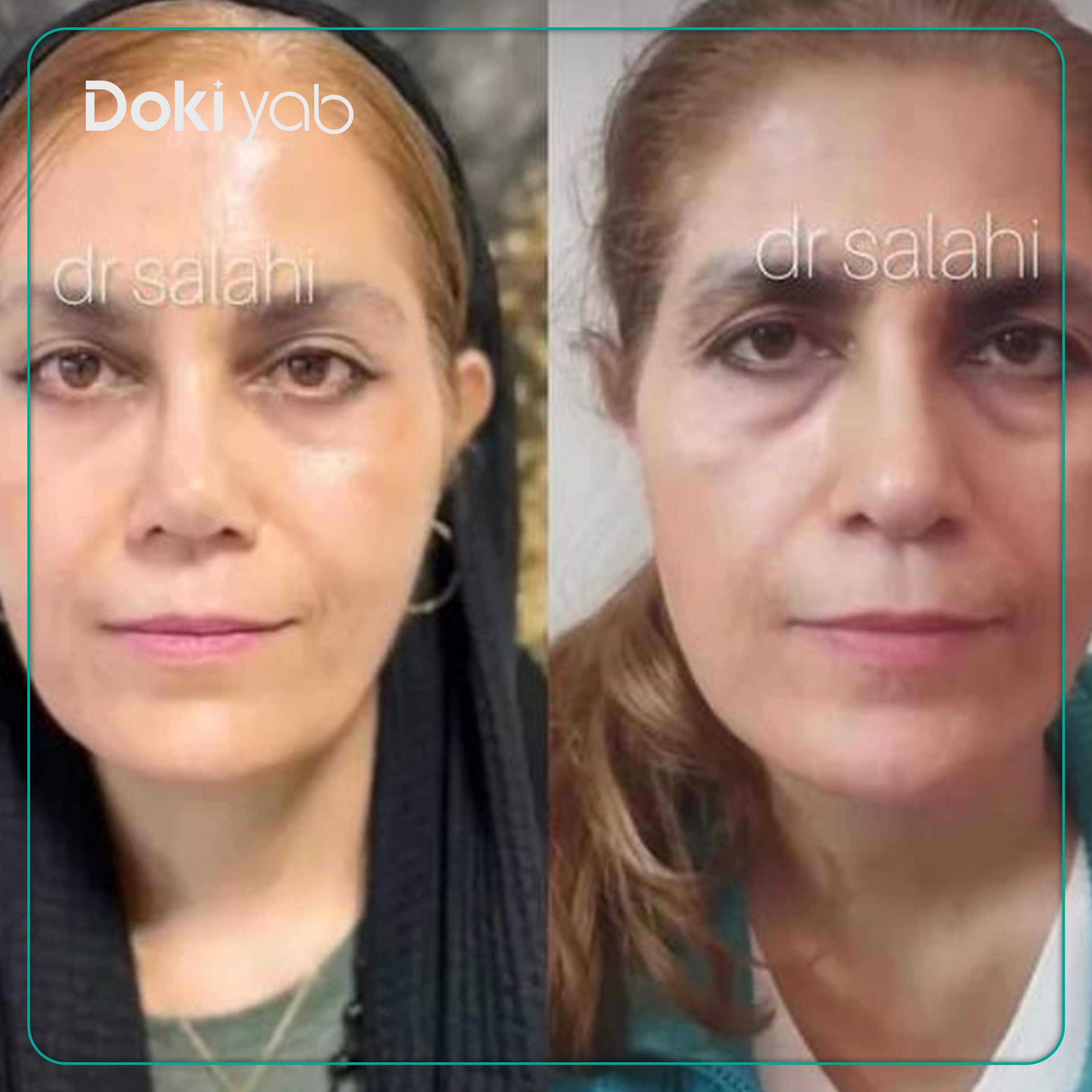 نمونه کار علی اصغر صلاحی جراح لیفت شقیقه در تهران