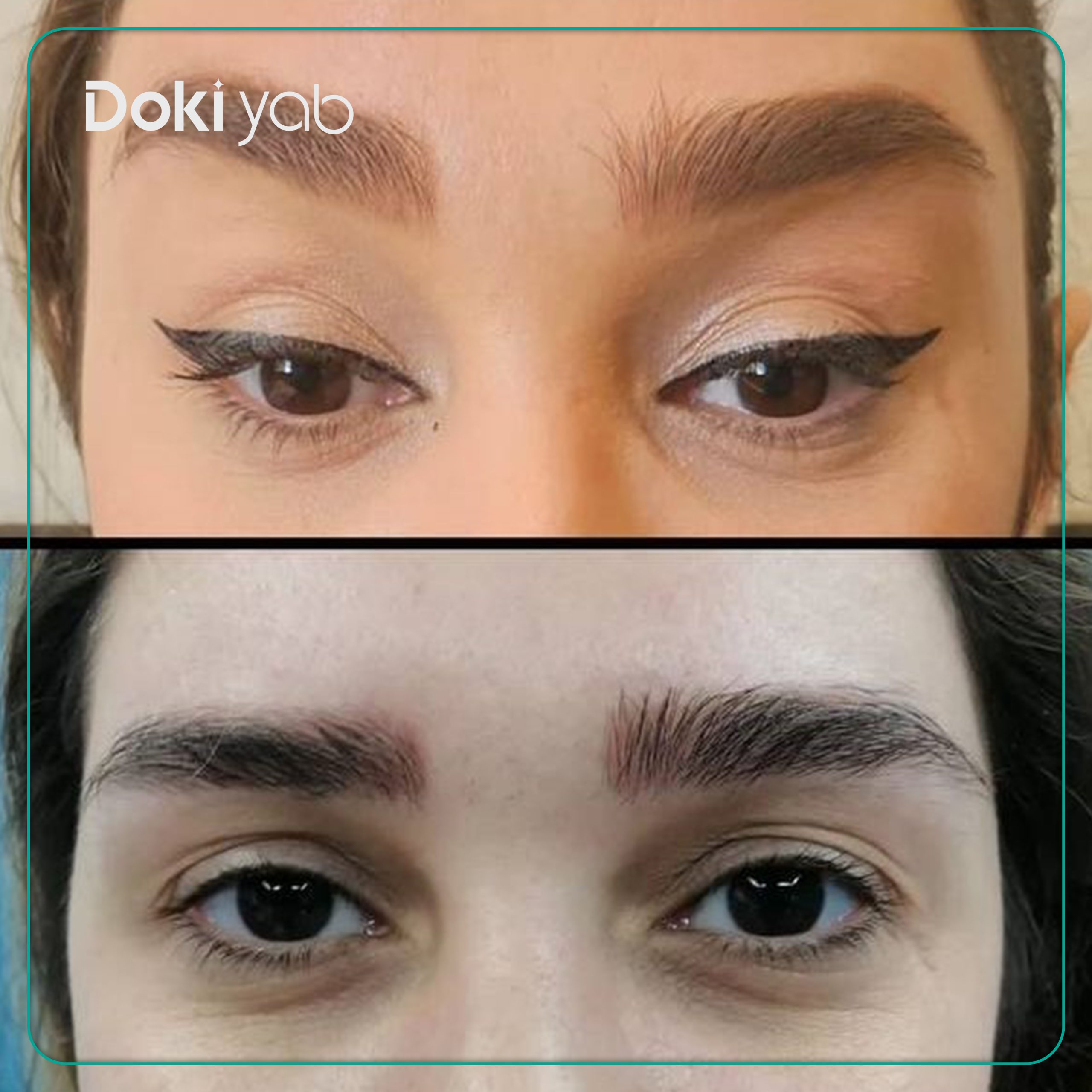 نمونه عمل لیفت شقیقه مجموعه دکی یاب