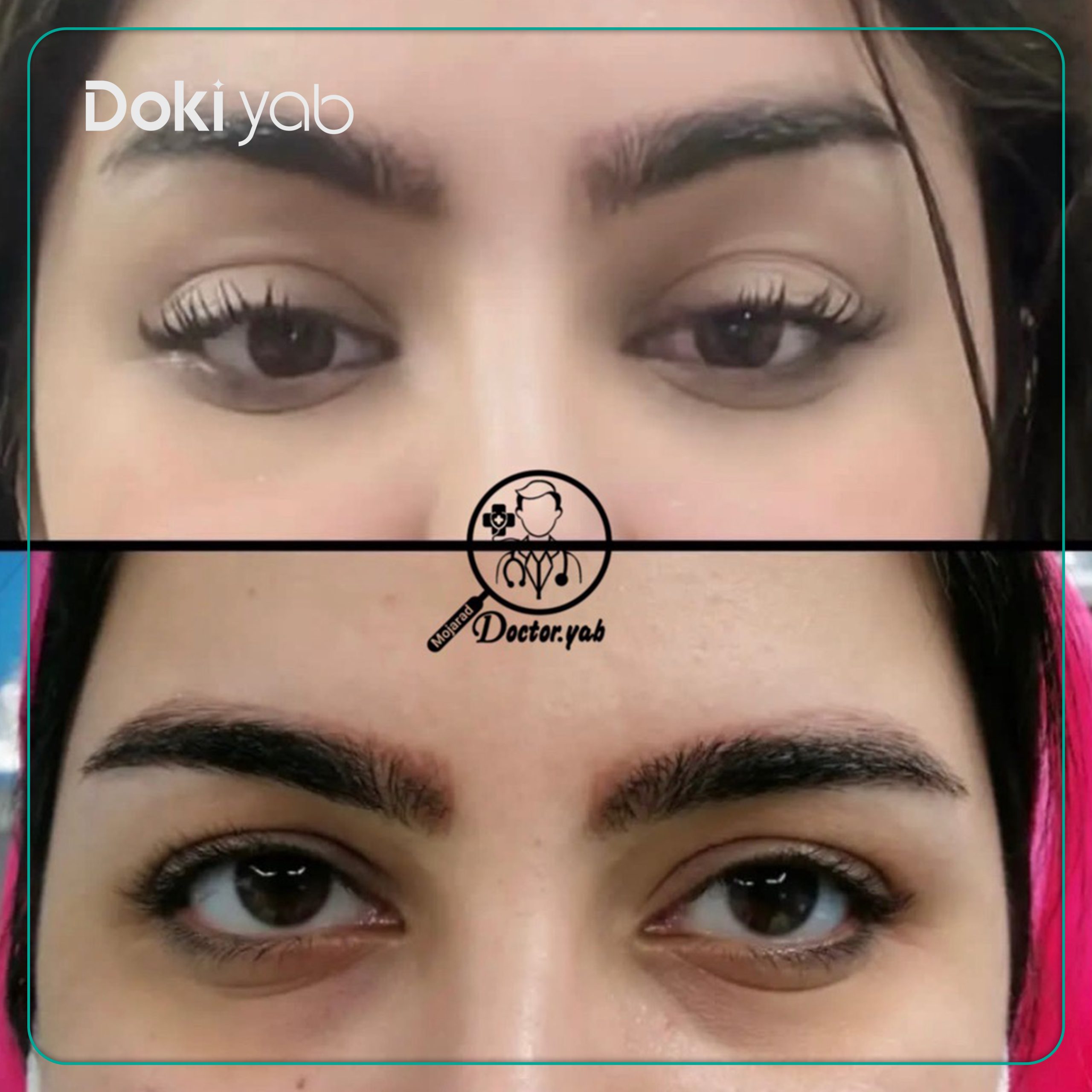 نمونه کار لیفت شقیقه مجموعه دکی یاب