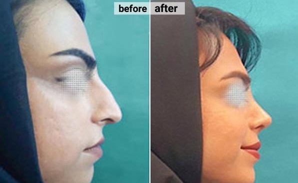 نمونه عمل بینی دکتر محمدرضا نیک تبار جراح بینی در یزد