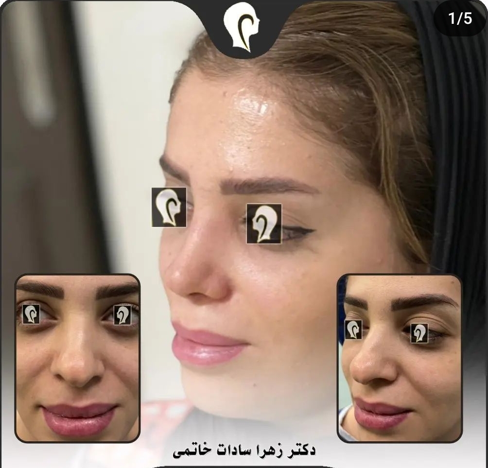 نمونه عمل بینی دکتر زهرا سادات خاتمی در بندرعباس