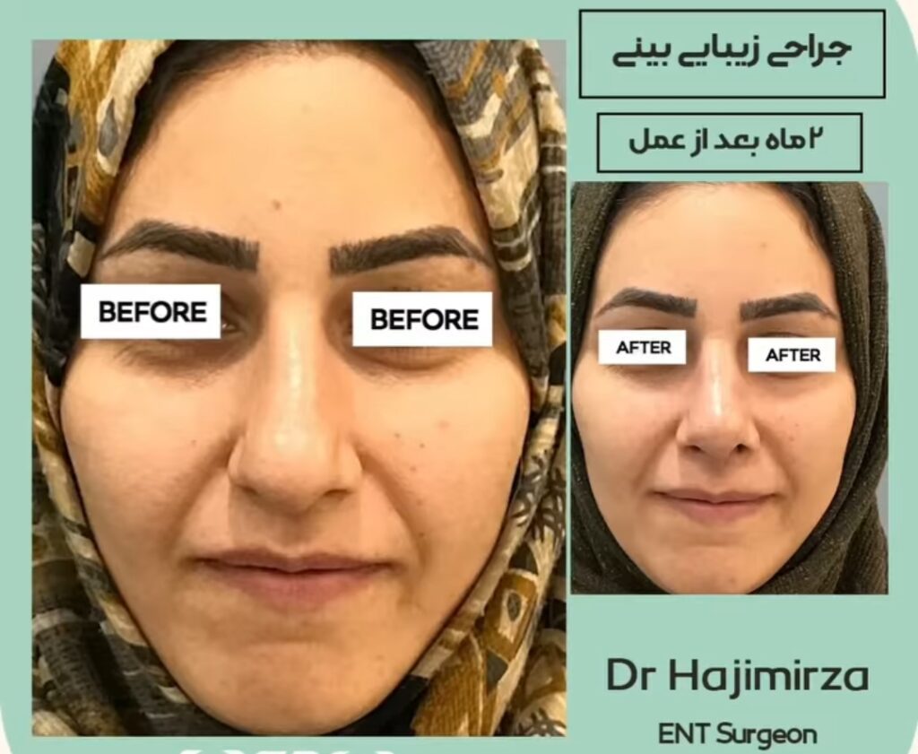 نمونه عمل بینی دکتر حاجی میرزا در یزد
