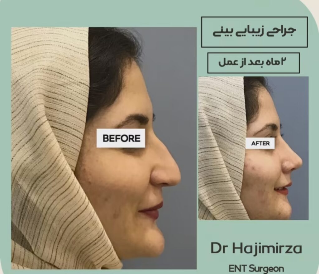 نمونه عمل بینی دکتر سید علیرضا حاجی میرزا در یزد