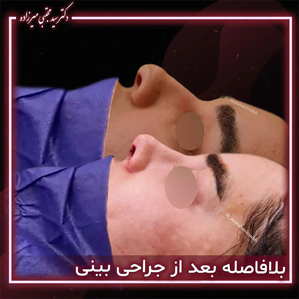 نمونه کار دکتر مجتبی میرزاده جراح بینی در یزد