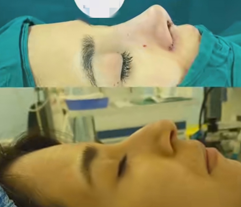 عمل بینی دکتر ساناز صفایی؛ بهترین جراح بینی در سمنان