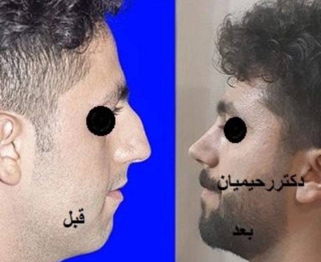 عمل بینی با دکتر شهرام رحیمیان؛ بهترین جراح بینی در سمنان