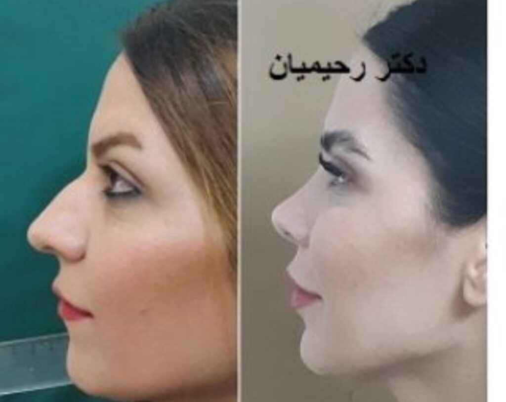 نمونه کار دکتر شهرام رحیمیان؛ بهترین جراح بینی در سمنان