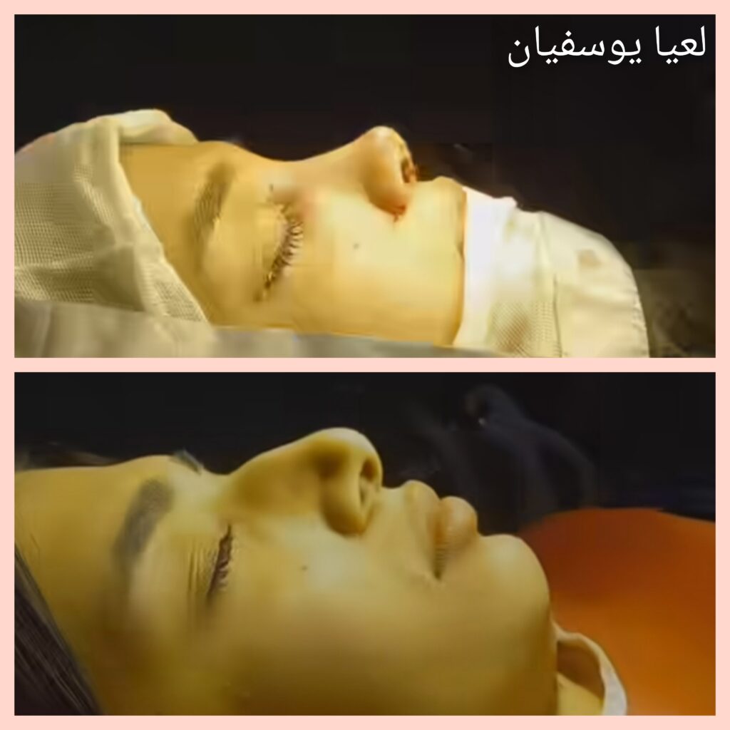 نمونه جراحی دکتر لعیا یوسفیان؛ بهترین جراح بینی در سمنان