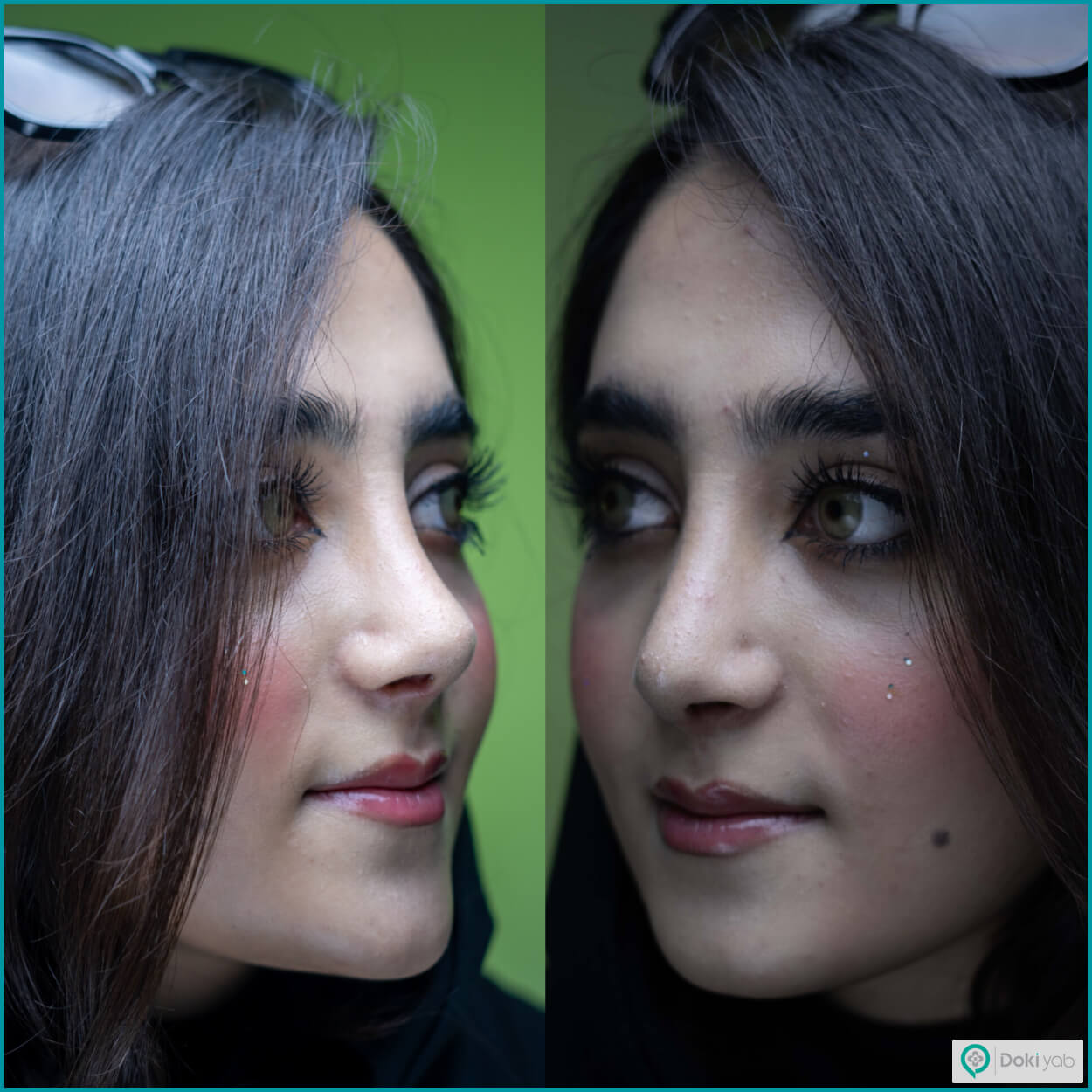 جراحی بینی با مشاوره تیم دکی یاب