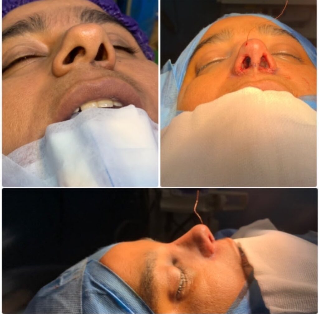 نمونه عمل بینی دکتر محمدجواد احمدی پور در بوشهر