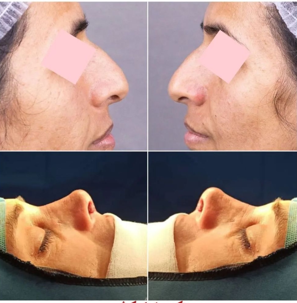 نمونه جراحی بینی دکتر سلمان کوثری در بوشهر