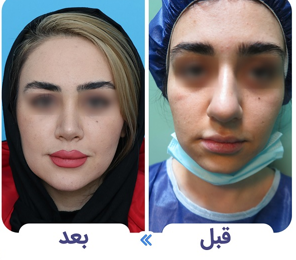 نمونه عمل بینی دکتر فتح اله بهنود در همدان