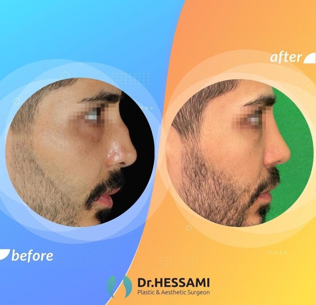 نمونه کار دکتر محمدحسین حسامی جراح بینی در مازندران