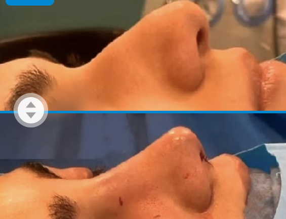 نمونه کار دکتر حسینی خواه بهترین جراح بینی در گرگان