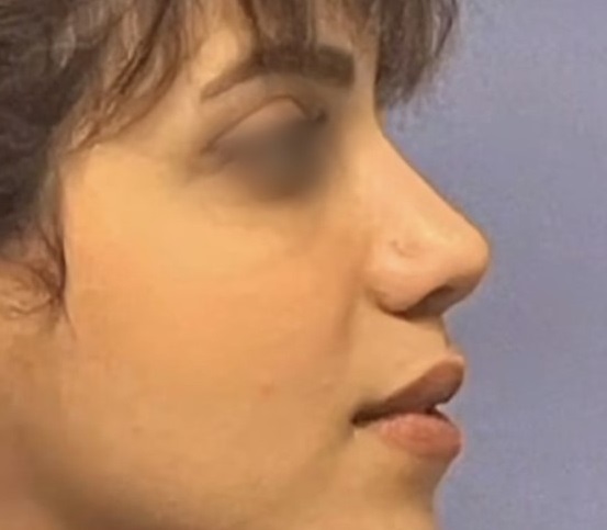 نمونه کار دکتر حسن حسینی خواه جراح بینی در گرگان