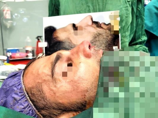 نمونه کار دکتر علی اکبر خدابخشی جراح بینی در اراک