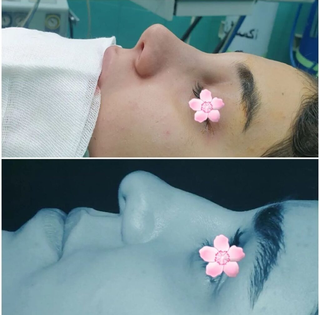 نمونه عمل بینی دکتر محمدرضا شبیری جراح بینی در همدان