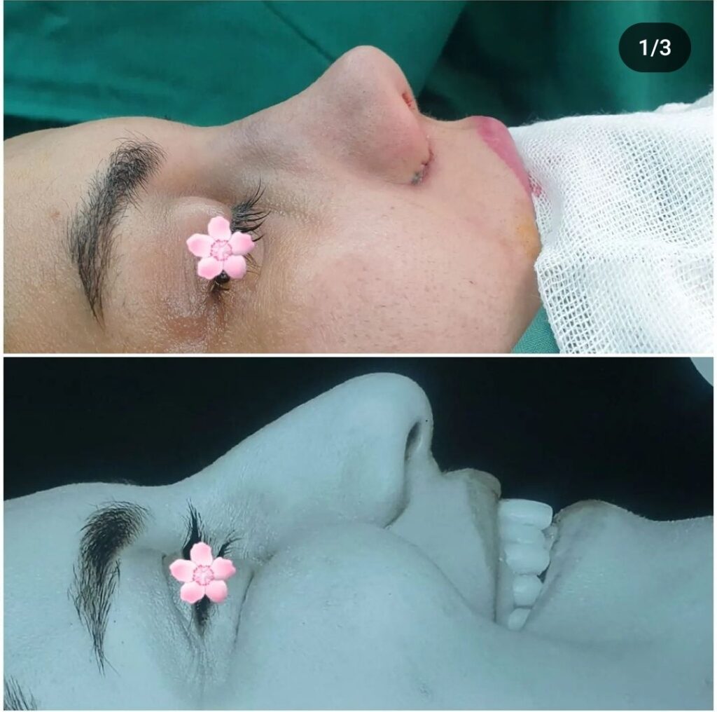 نمونه جراحی بینی دکتر محمدرضا شبیری در همدان