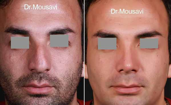 نمونه جراحی بینی دکتر سید محسن موسوی در همدان