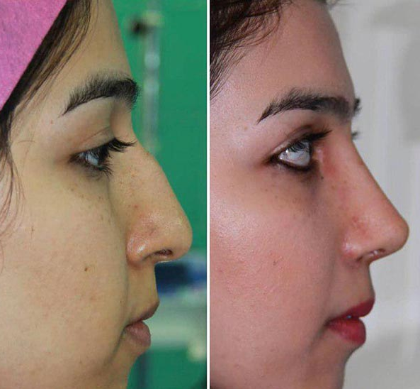 نمونه جراحی بینی دکتر فرناز هاشمیان در همدان