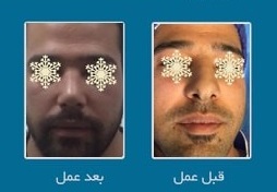 نمونه عمل جراحی بینی دکتر پیام واردی در قزوین
