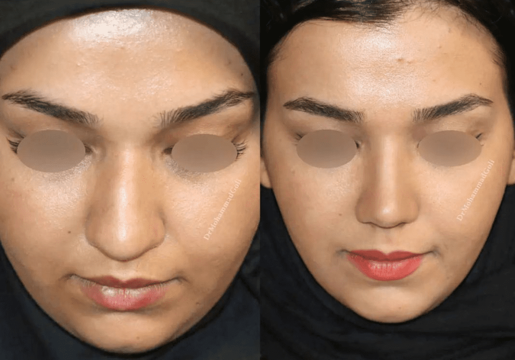 نمونه عمل بینی دکتر محمد گلی جراح بینی در قزوین