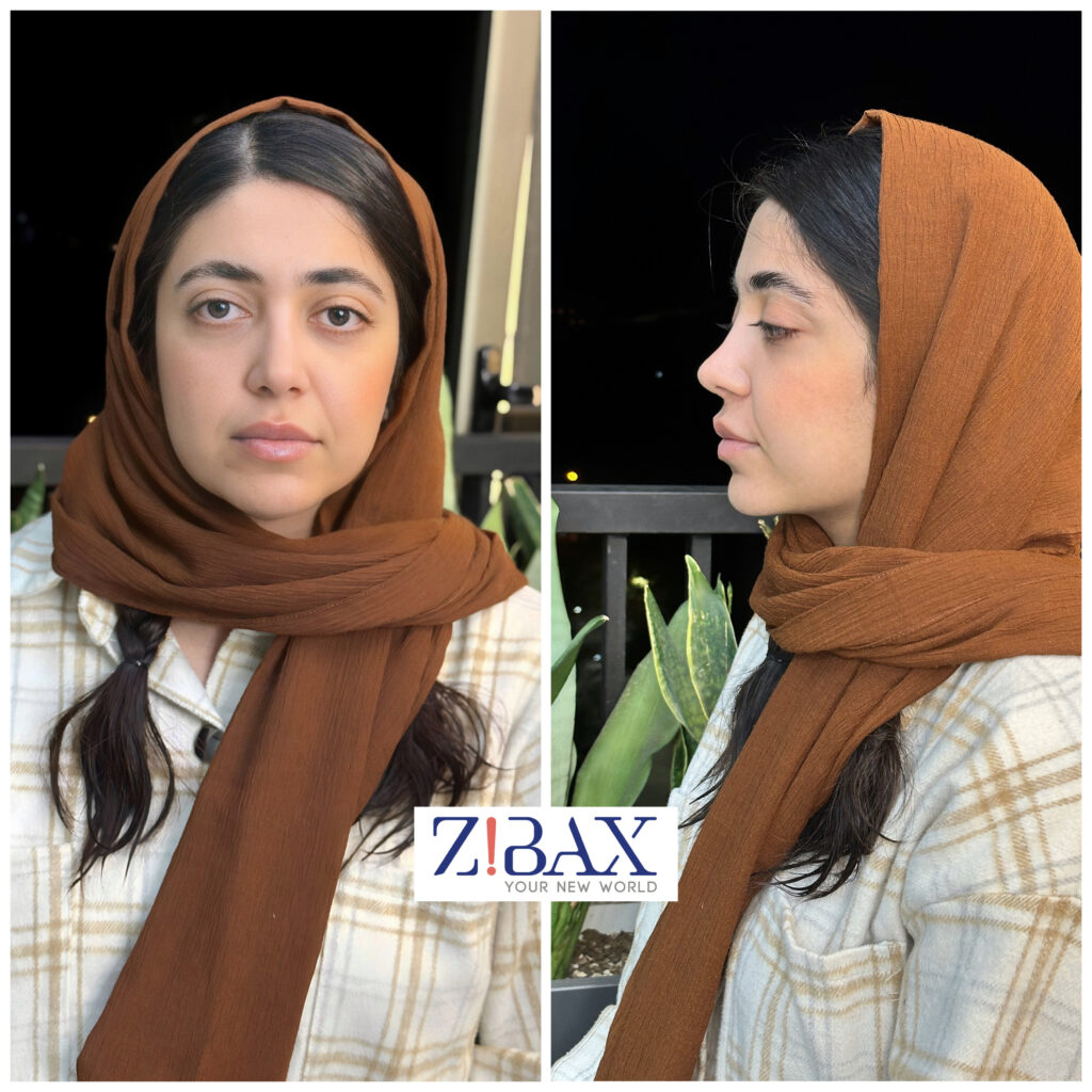 نمونه عمل زیبایی بینی مجموعه دکی یاب؛ بهترین جراح بینی استخوانی در تهران