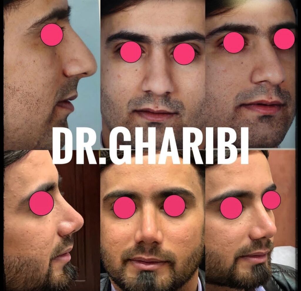 نمونه جراحی بینی دکتر رضا غریبی؛ بهتربن جراح بینی در چابهار