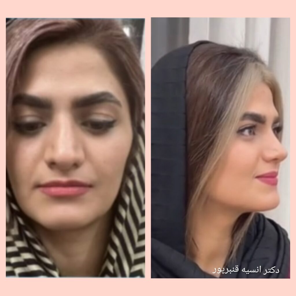 عمل زیبایی بینی دکتر انسیه قنبرپور؛ بهتربن جراح بینی در چابهار